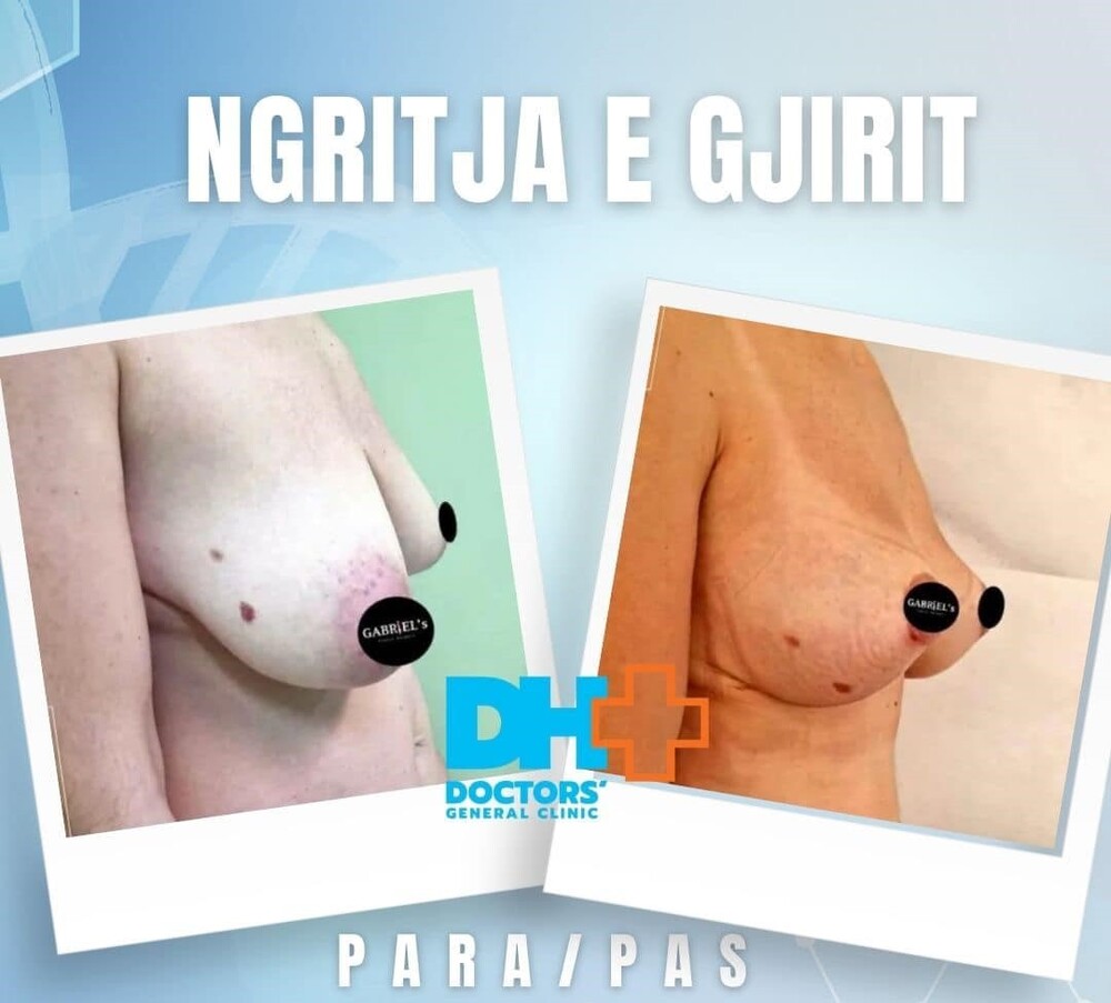 Before and After Result